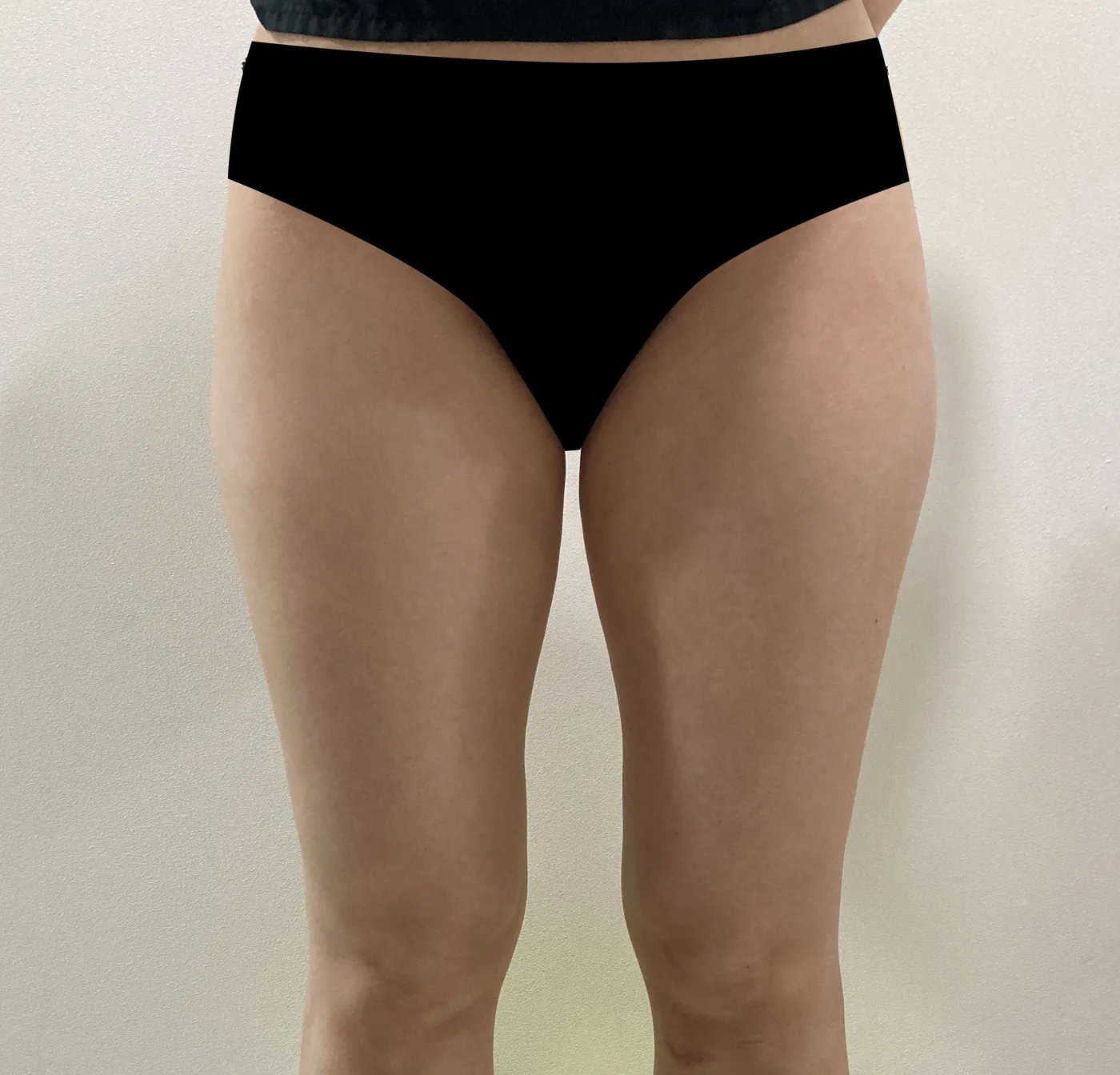 G-fat inner thigh extraction before, G Clinic Gangnam case 68