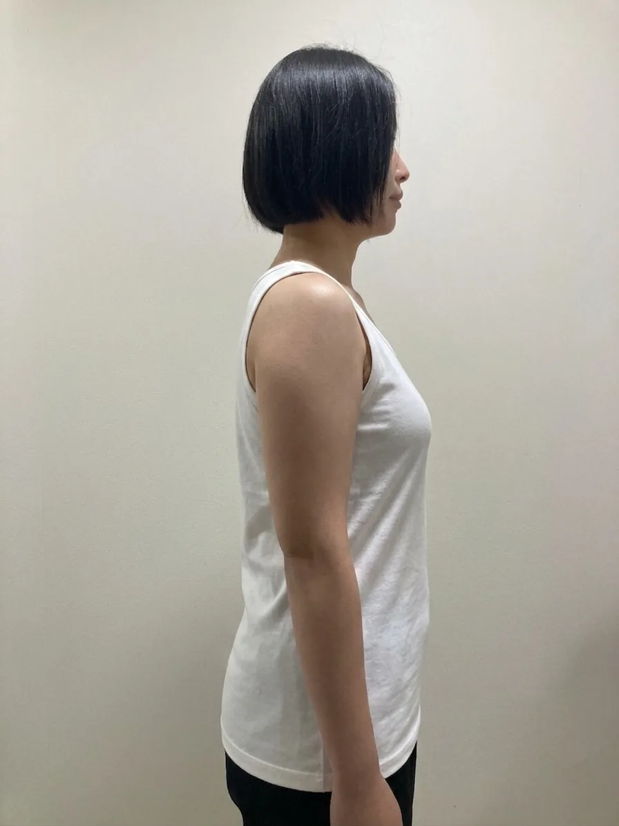 G-fat arm extraction before, G Clinic Gangnam case 69
