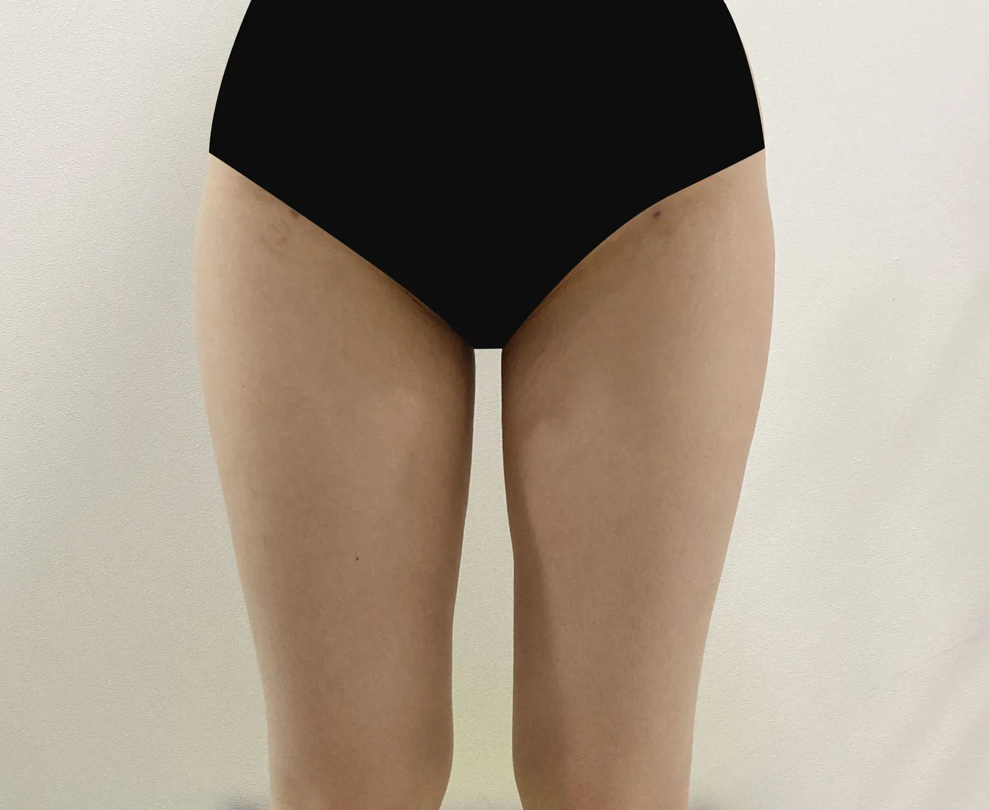 G-fat inner thigh extraction after, G Clinic Gangnam case 71