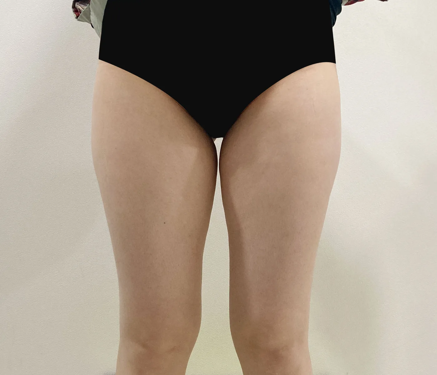 G-fat inner thigh extraction before, G Clinic Gangnam case 71