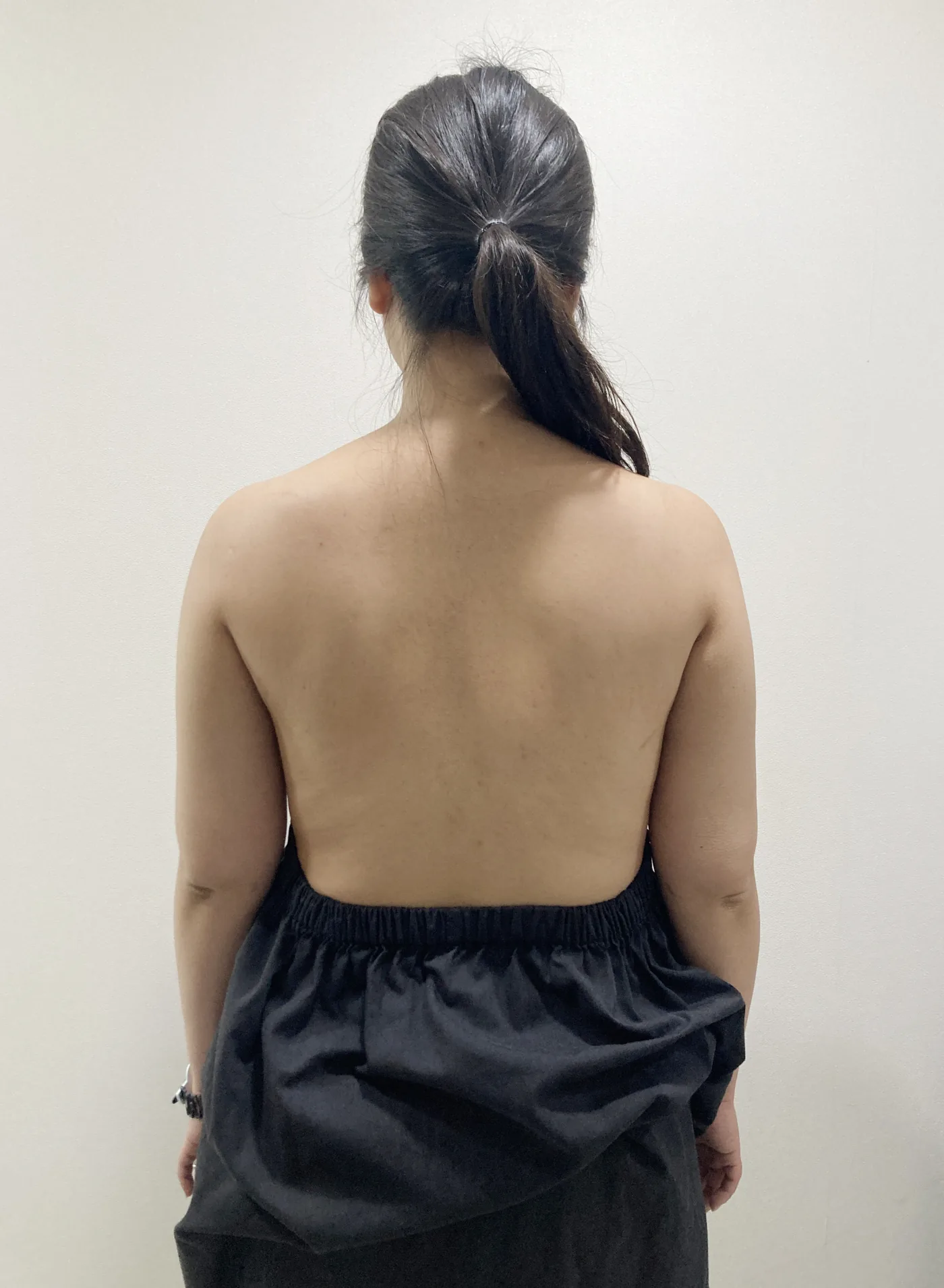 Arm G-fat after, clinic-reported case
