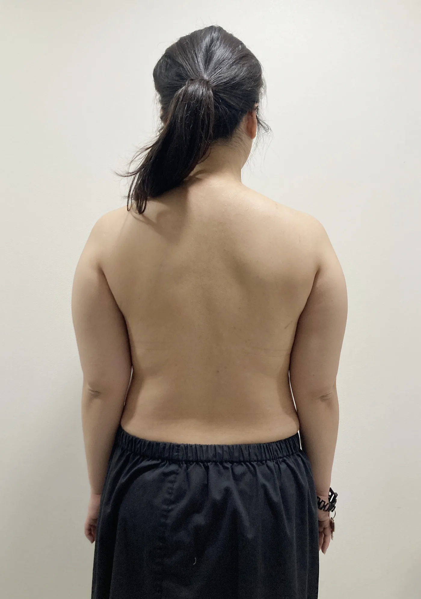 Arm G-fat before, clinic-reported case