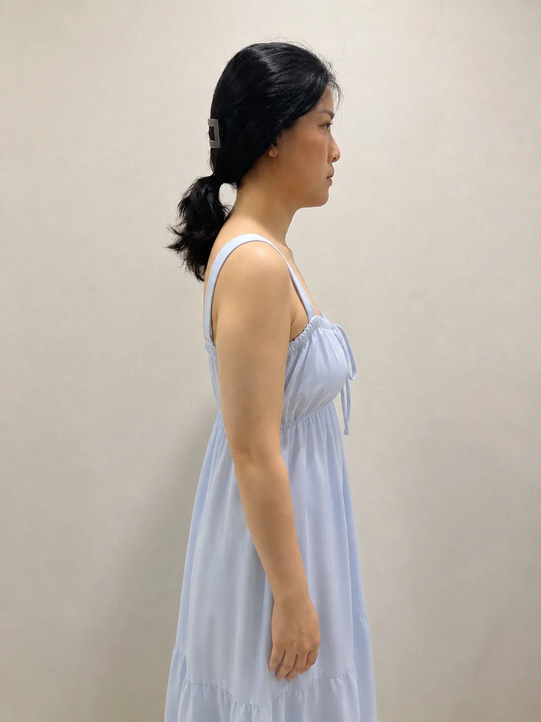 G-fat arm extraction after, G Clinic Gangnam case 73
