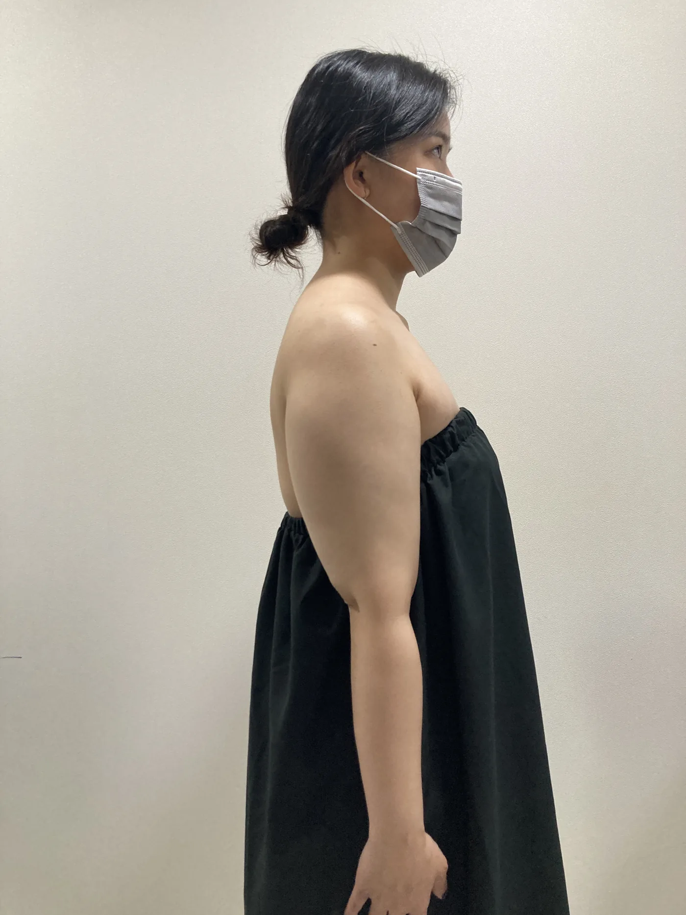 G-fat arm extraction before, G Clinic Gangnam case 73
