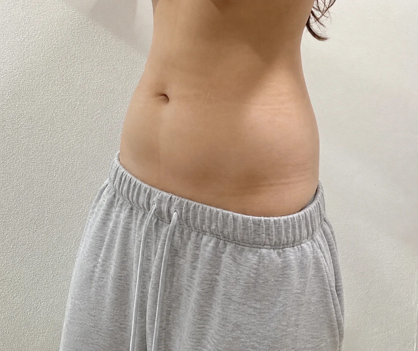 استخراج جي-فات لدهون البطن قبل الجلسة، G Clinic كانغنام الحالة 74