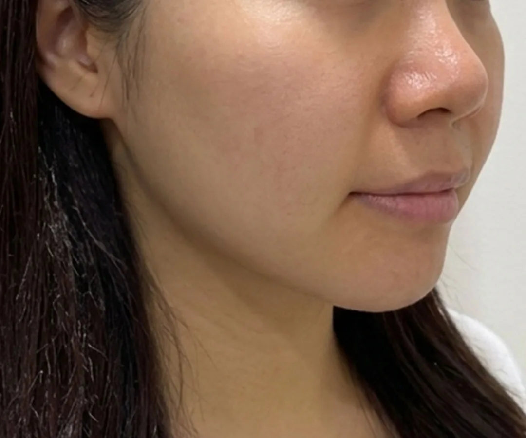 Ultherapy Prime face lifting after, G Clinic Gangnam case 01