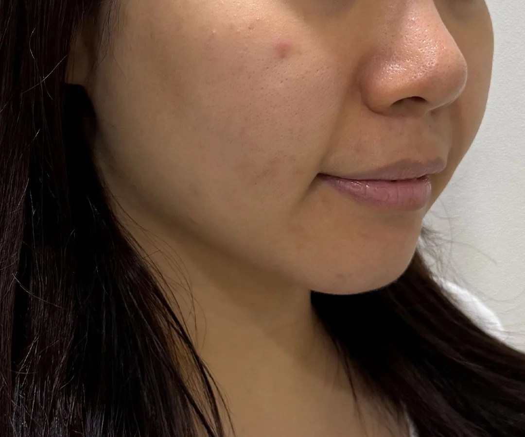 Ultherapy Prime face lifting before, G Clinic Gangnam case 01