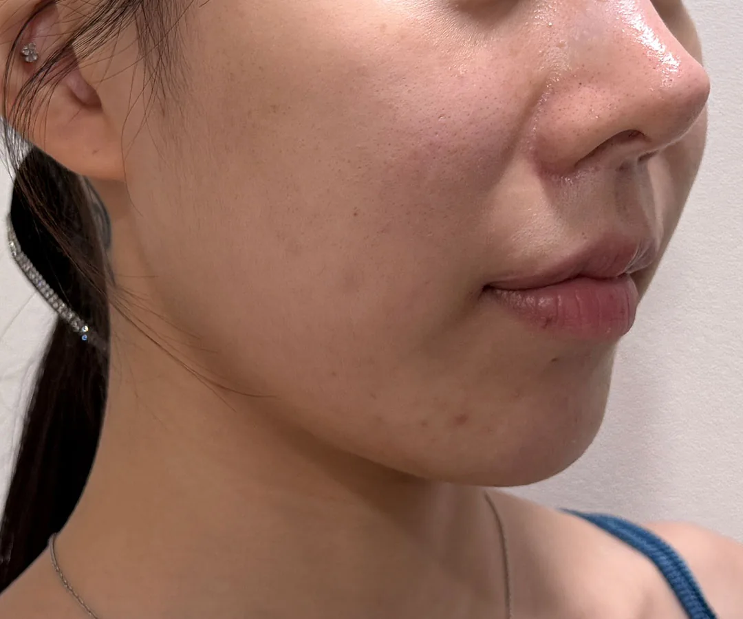 Ultherapy Prime face lifting before, G Clinic Gangnam case 02