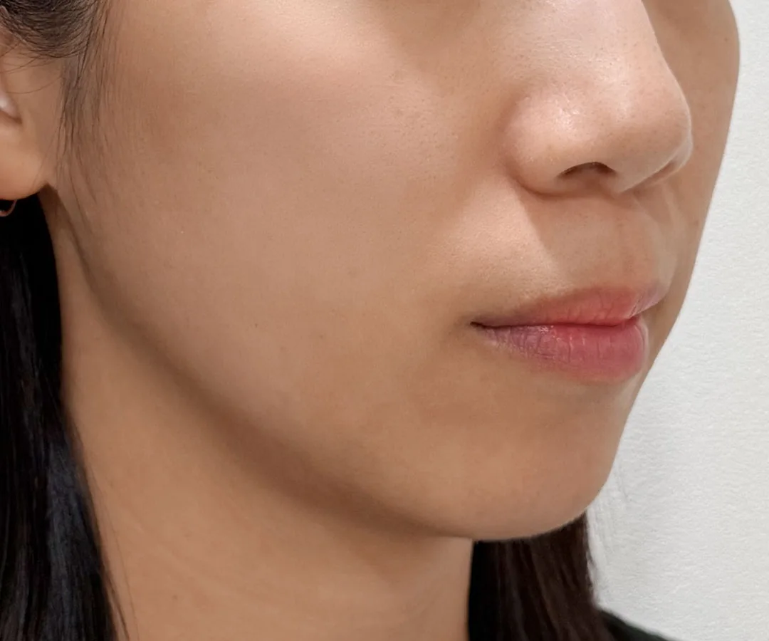 Ultherapy Prime face lifting after, G Clinic Gangnam case 03