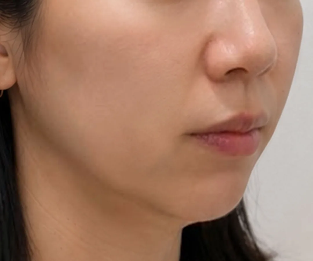 Ultherapy Prime face lifting before, G Clinic Gangnam case 03